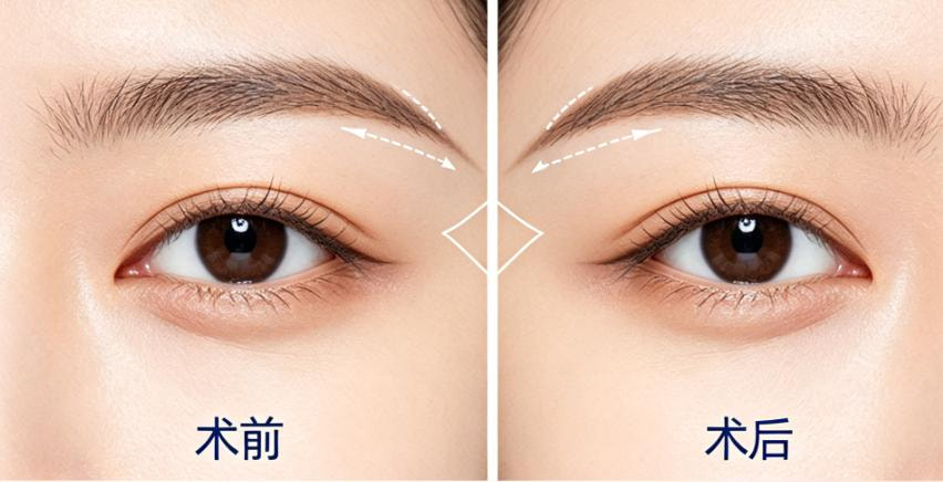 单纯开外眼角