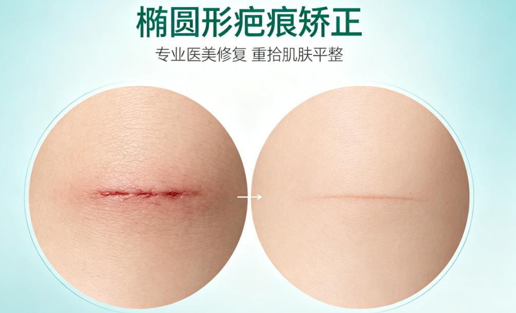 疤痕