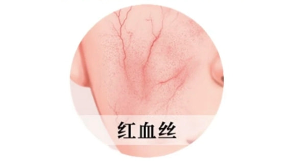 去红血丝