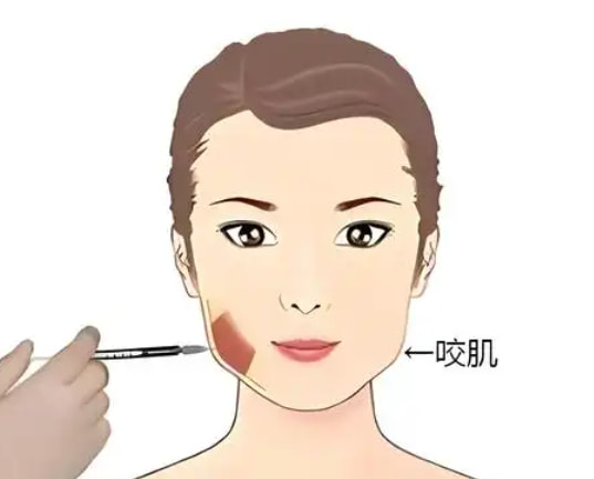 注射瘦脸.png