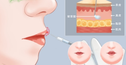 精塑脸型 轮廓清晰 足量注射