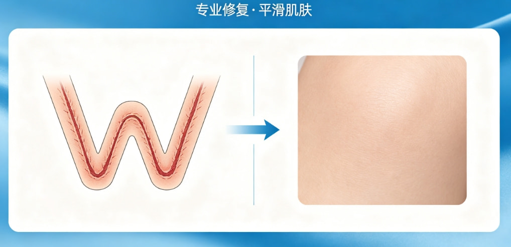 W型疤痕矫正1.png