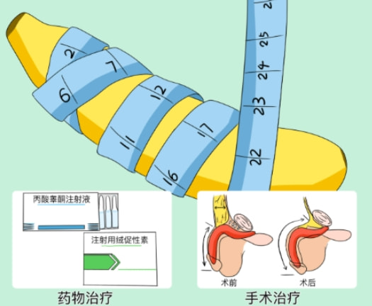 阴茎延长