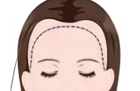 发际线矫正1.png
