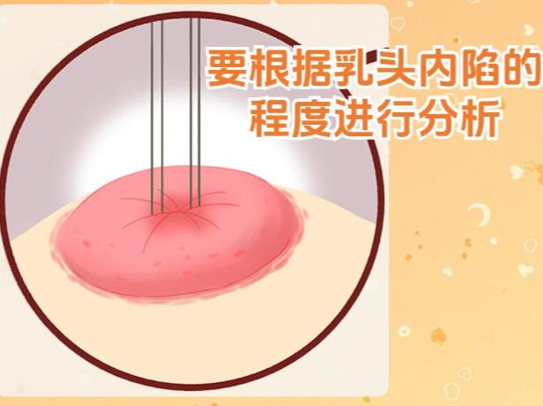【乳头内陷矫正】