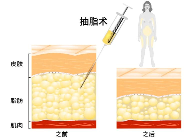 吸脂手术.jpg