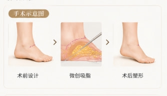 脚踝吸脂