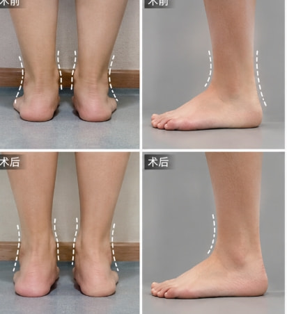 脚踝吸脂