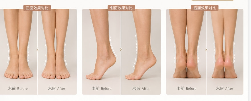 脚踝吸脂