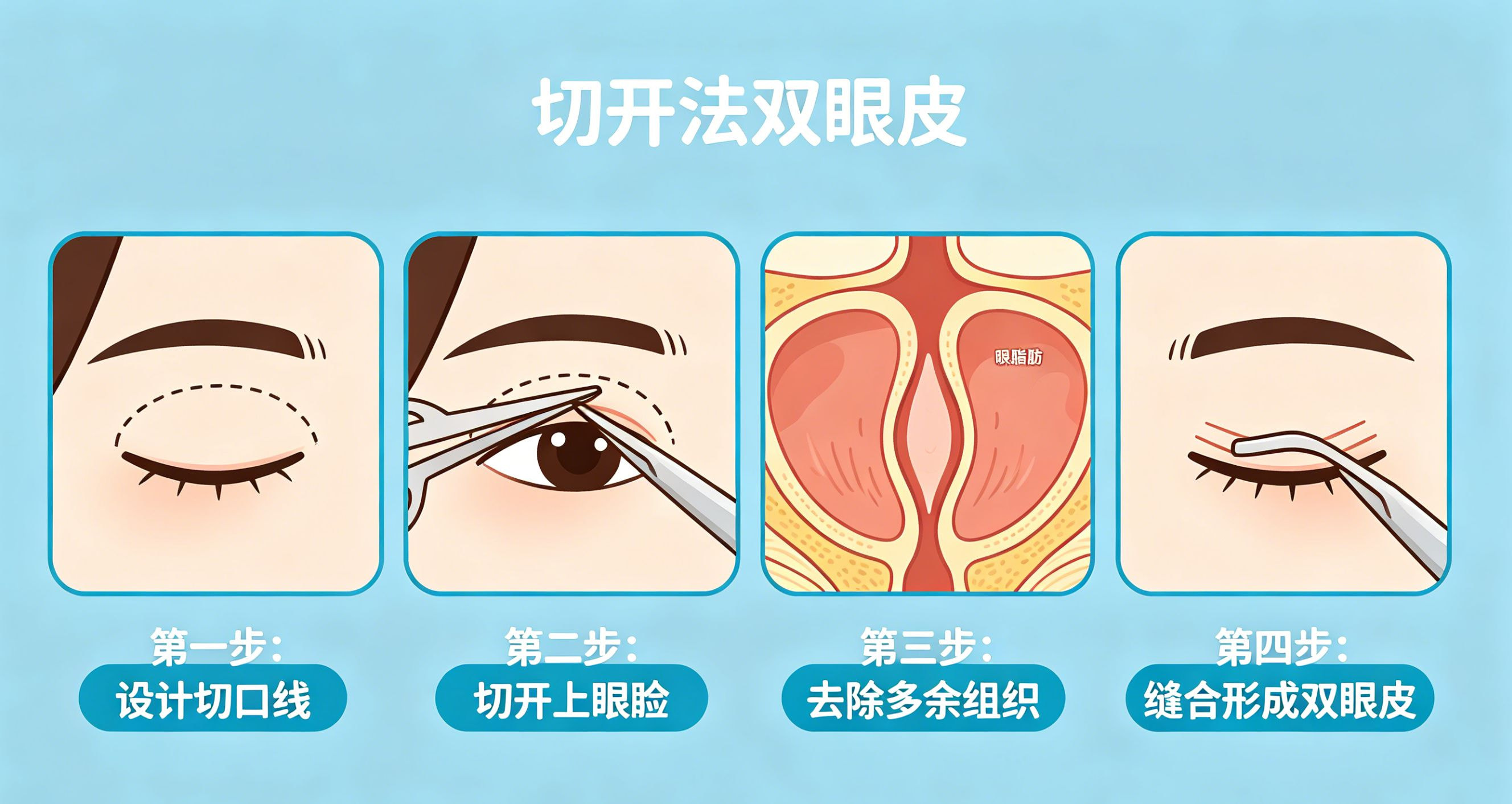 部分切开双眼皮1.jpg
