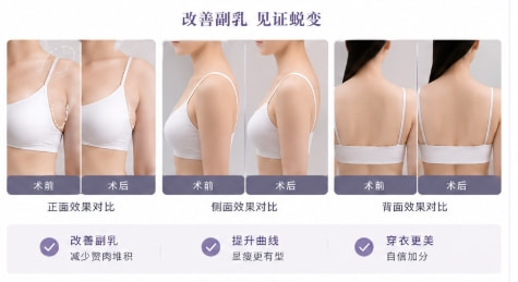 [手术去副乳]精细分层去乳房赘肉脂肪
