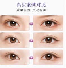 单纯开内眼角