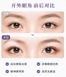单纯开内眼角