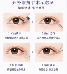 开外眼角2.png