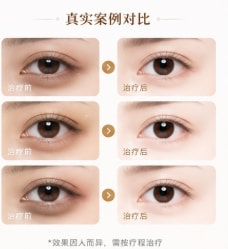 激光去黑眼圈2.png