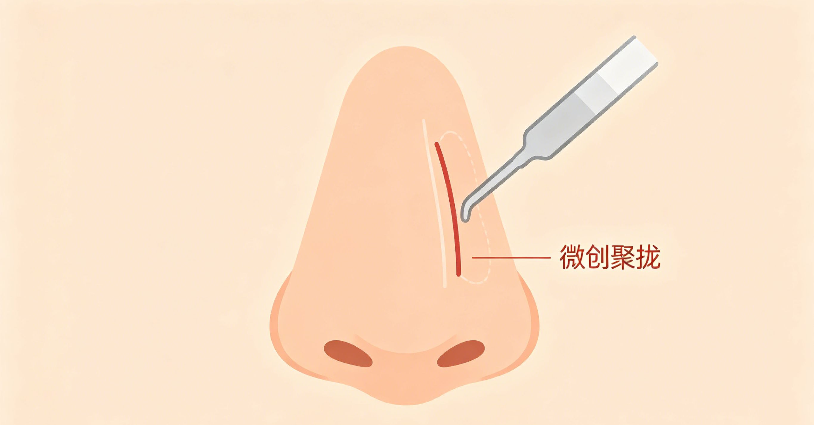 鼻翼缩小4.jpg