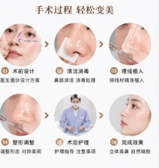 埋线隆鼻