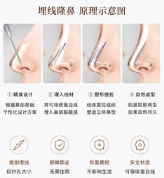 埋线隆鼻