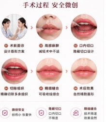 单侧唇裂修复