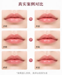 单侧唇裂修复