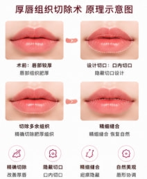 单侧唇裂修复