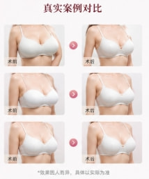 巨乳缩小整形