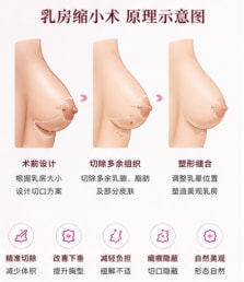 乳房缩小1.png