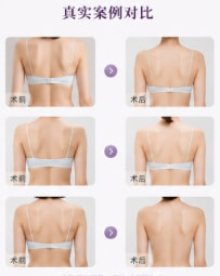 背部吸脂(富贵包 / 副乳)