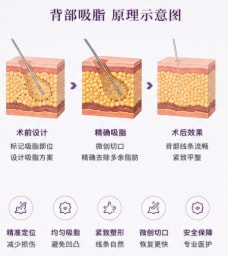 背部吸脂(富贵包 / 副乳)