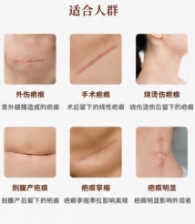 【激光淡疤】【大面积疤痕修复】烫伤疤痕激光去疤