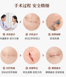 Z型疤痕矫正4.png