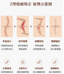 【激光淡疤】【大面积疤痕修复】烫伤疤痕激光去疤