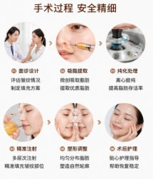 注射自体脂肪去皱