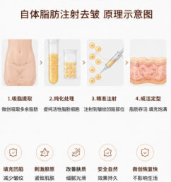 注射自体脂肪去皱