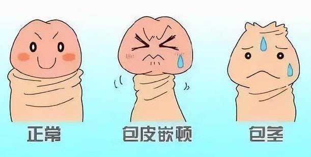 阴茎增粗
