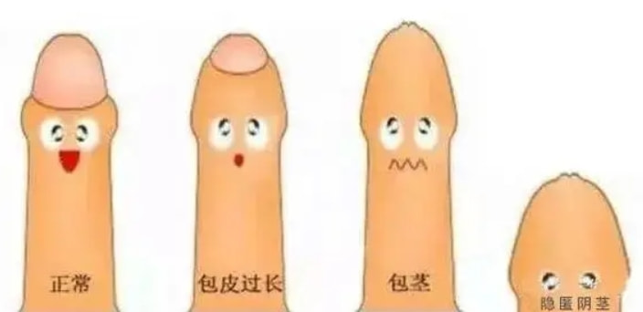 阴茎增粗