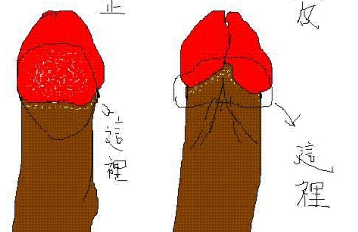 阴茎增粗