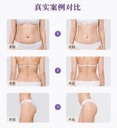 全身吸脂2.png