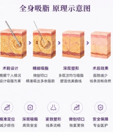 全身吸脂