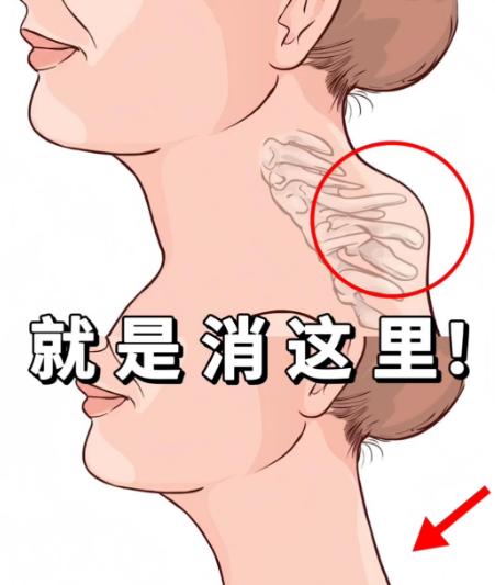 微创去除富贵包