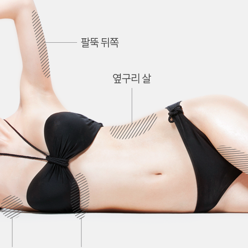 手术去副乳