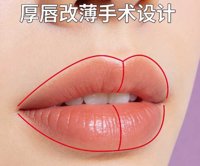 二期唇裂疤痕修复