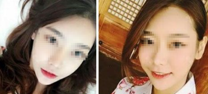 假体隆鼻半年后约了知名度较高的武汉五洲莱美朴光哲做磨骨去下颌角+颧骨缩小手术 案例图2