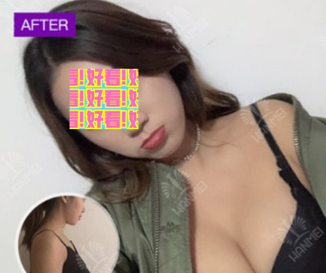 太全面!您有一份遵义韩美整形价格和隆胸吸脂祛斑等案例效果图,请查收。 图2