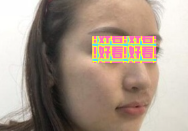必须得说我被遵义韩美做的这个瘦脸+假体垫下巴后的我迷住了。