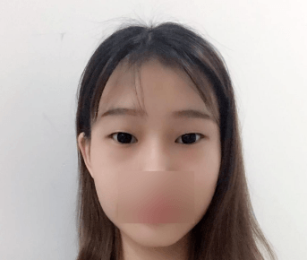 汕头曙光割双眼皮多少钱?我找殷运成医生做的眼综合花了一万多元效果还不错