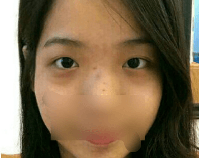 我的双眼皮和隆鼻是找湛江澳泰整形医院张维华做的超级好看
