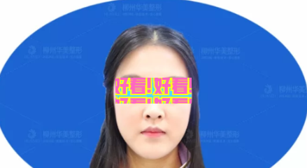 柳州华美隆鼻怎么样？王文院长肋软骨鼻综合修复案例过程大起底