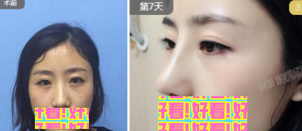公开！烟台鹏爱整形医院pk烟台美神美容医院，手术价格+鼻综合自体脂肪填充切开双眼皮实例