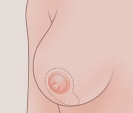 【乳头缩小】